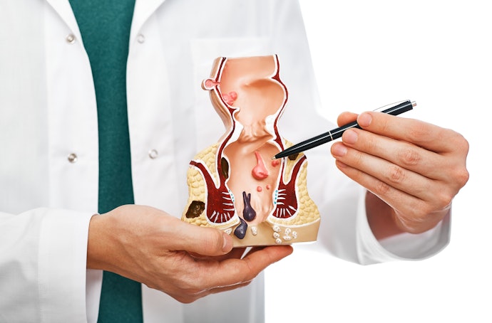 Como Diagnosticar Hemorroidas?
